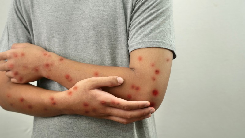 bị thủy đậu có được uống trà sữa không