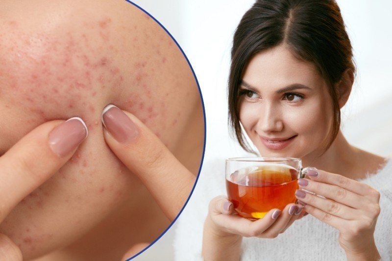 Uống trà có trị mụn không?