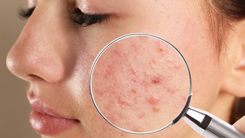 uống trà shan tuyết có trị mụn không