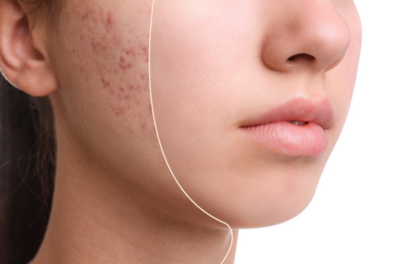 uống trà trị mụn